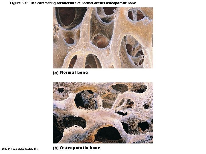 Figure 6. 16 The contrasting architecture of normal versus osteoporotic bone. Normal bone ©