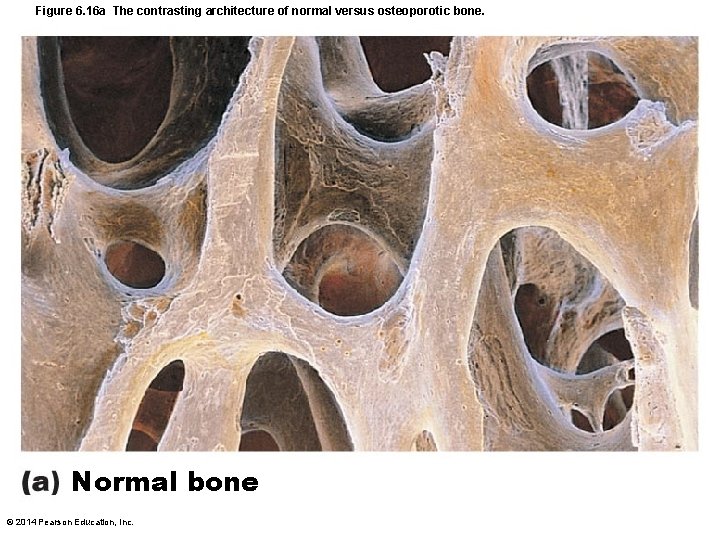 Figure 6. 16 a The contrasting architecture of normal versus osteoporotic bone. Normal bone