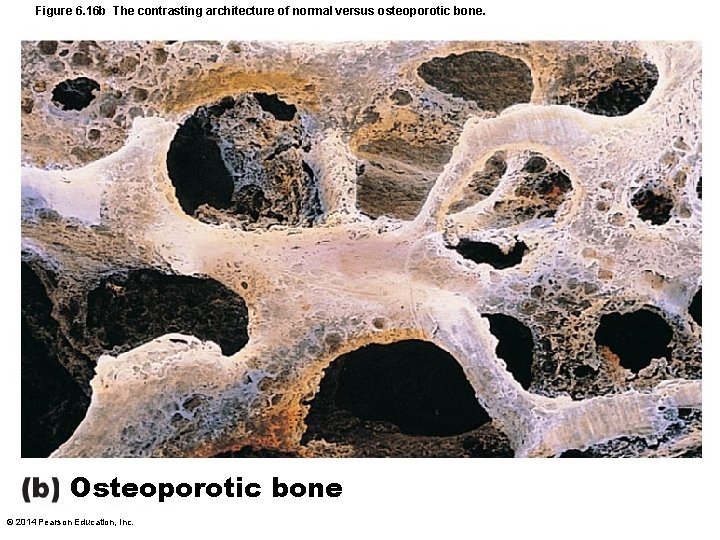 Figure 6. 16 b The contrasting architecture of normal versus osteoporotic bone. Osteoporotic bone