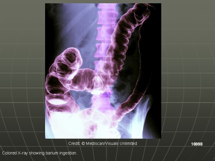 Credit: © Mediscan/Visuals Unlimited Colored X-ray showing barium ingestion. 16998 