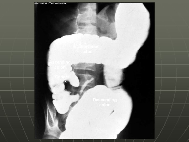 Figure 45 -12 Page 886 Transverse colon Ascending colon Cancer Descending colon 