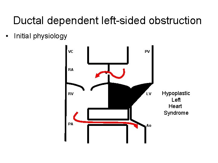 Ductal dependent left-sided obstruction • Initial physiology VC PV RA RV LV PA Ao