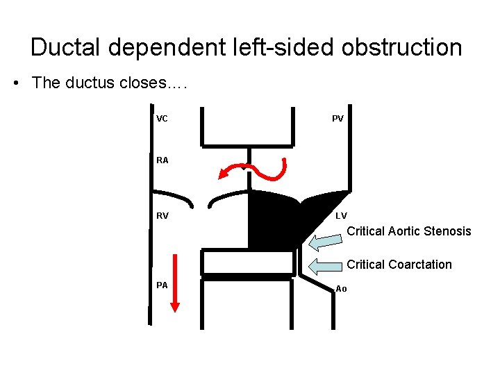 Ductal dependent left-sided obstruction • The ductus closes…. VC PV RA RV LV Critical