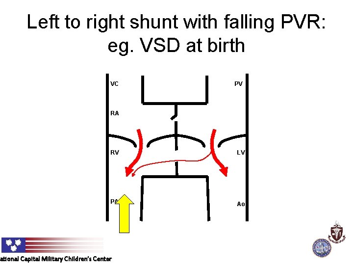 Left to right shunt with falling PVR: eg. VSD at birth VC PV RA