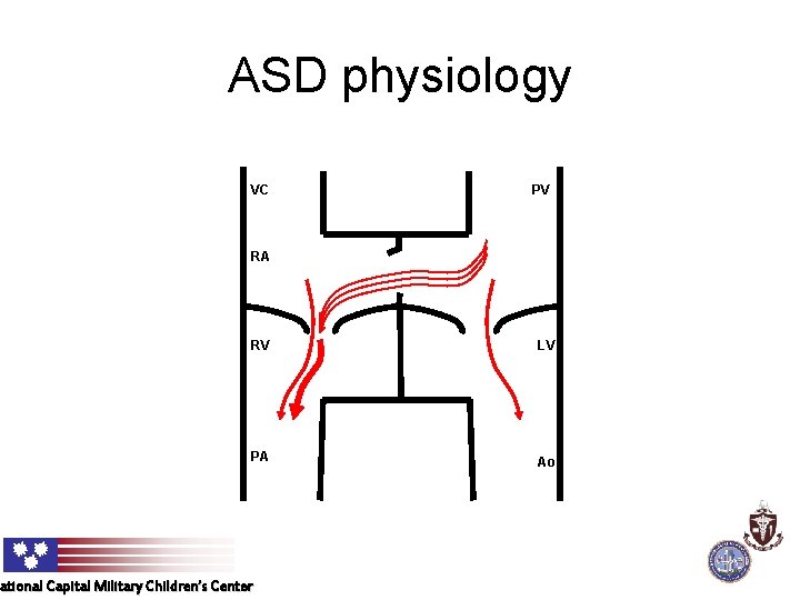 ASD physiology VC PV RA RV LV PA Ao ational Capital Military Children’s Center