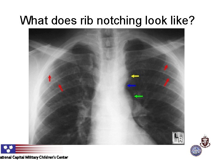 What does rib notching look like? ational Capital Military Children’s Center National 