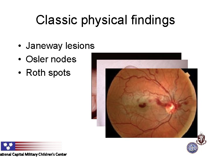 Classic physical findings • Janeway lesions • Osler nodes • Roth spots ational Capital