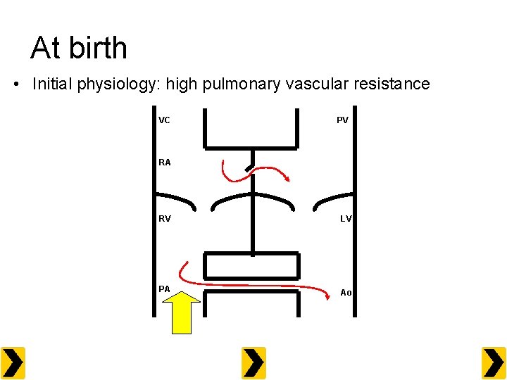 At birth • Initial physiology: high pulmonary vascular resistance VC PV RA RV LV