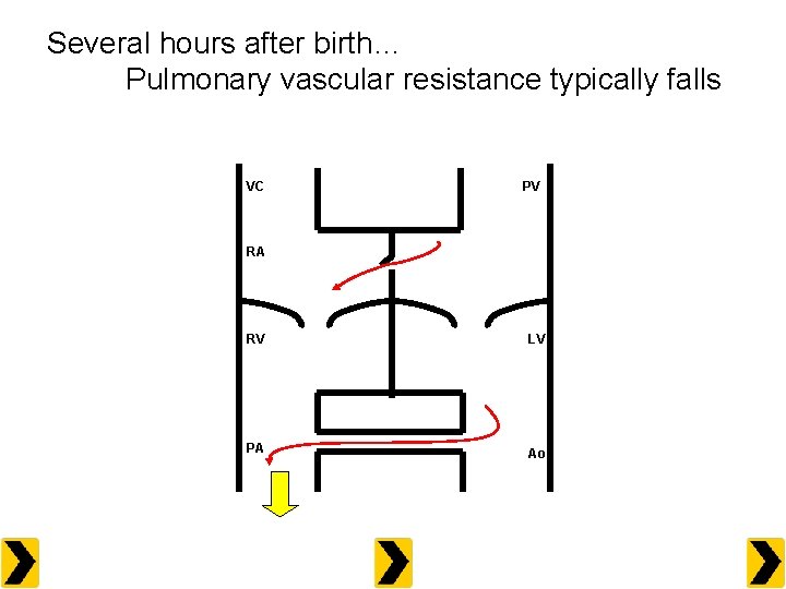 Several hours after birth… Pulmonary vascular resistance typically falls VC PV RA RV LV