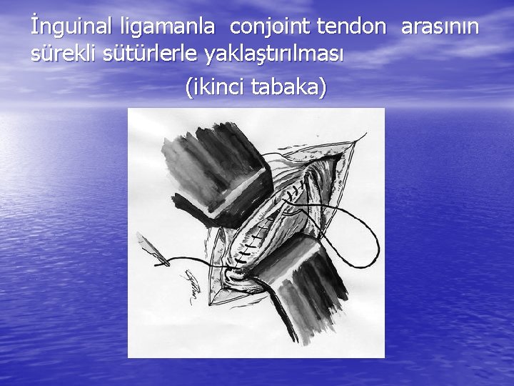 İnguinal ligamanla conjoint tendon arasının sürekli sütürlerle yaklaştırılması (ikinci tabaka) 
