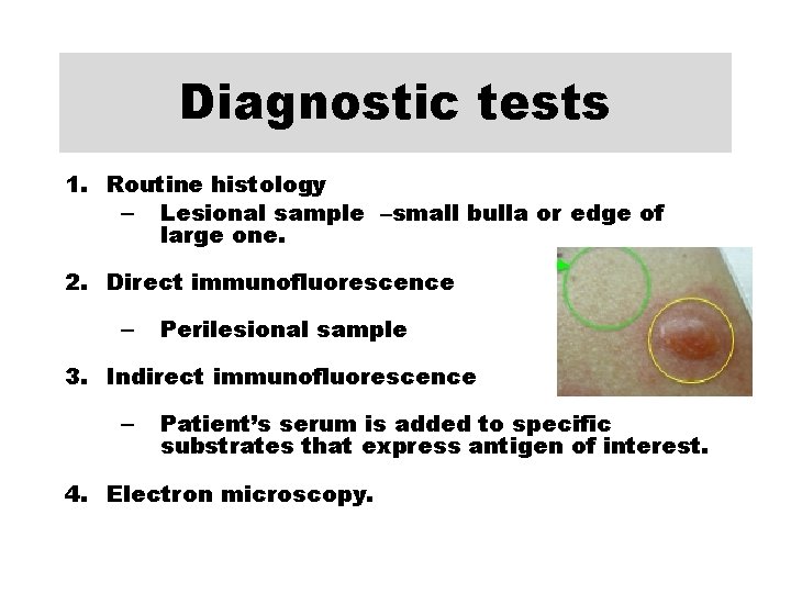 Diagnostic tests 1. Routine histology – Lesional sample –small bulla or edge of large