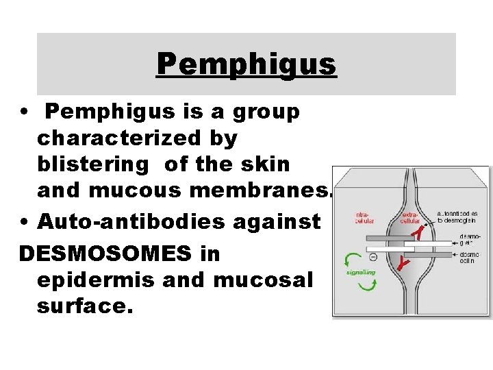 Pemphigus • Pemphigus is a group characterized by blistering of the skin and mucous