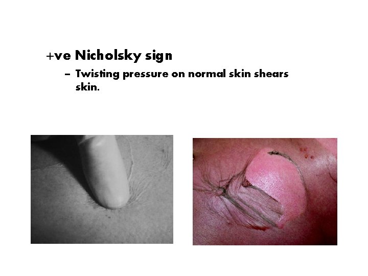 +ve Nicholsky sign – Twisting pressure on normal skin shears skin. 