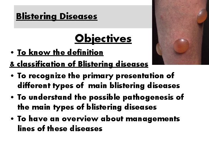 Blistering Diseases Objectives • To know the definition & classification of Blistering diseases •