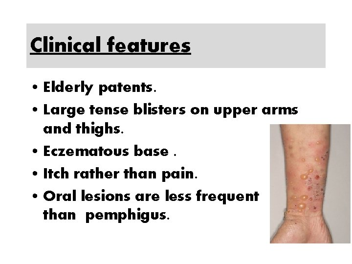Clinical features • Elderly patents. • Large tense blisters on upper arms and thighs.