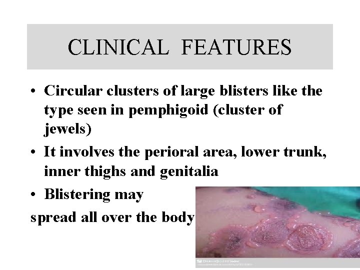 CLINICAL FEATURES • Circular clusters of large blisters like the type seen in pemphigoid