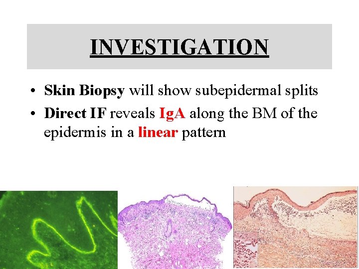 INVESTIGATION • Skin Biopsy will show subepidermal splits • Direct IF reveals Ig. A