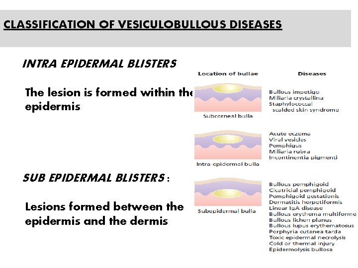 CLASSIFICATION OF VESICULOBULLOUS DISEASES INTRA EPIDERMAL BLISTERS The lesion is formed within the epidermis
