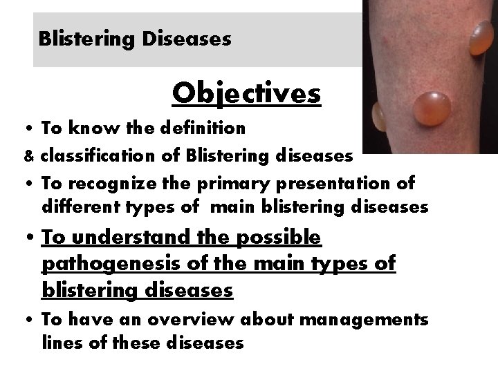 Blistering Diseases Objectives • To know the definition & classification of Blistering diseases •
