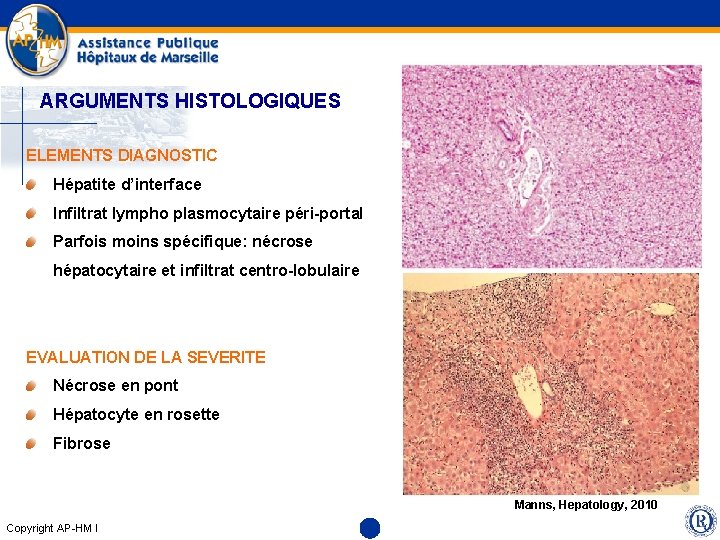 ARGUMENTS HISTOLOGIQUES ELEMENTS DIAGNOSTIC Hépatite d’interface Infiltrat lympho plasmocytaire péri-portal Parfois moins spécifique: nécrose