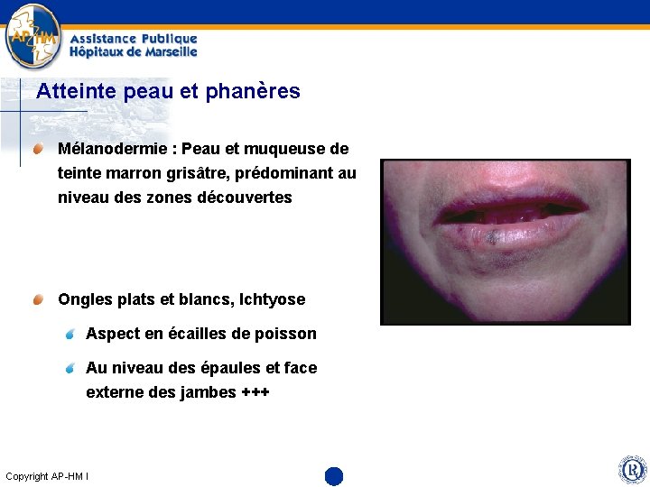 Atteinte peau et phanères Mélanodermie : Peau et muqueuse de teinte marron grisâtre, prédominant