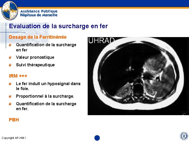 Evaluation de la surcharge en fer Dosage de la Ferritinémie Quantification de la surcharge