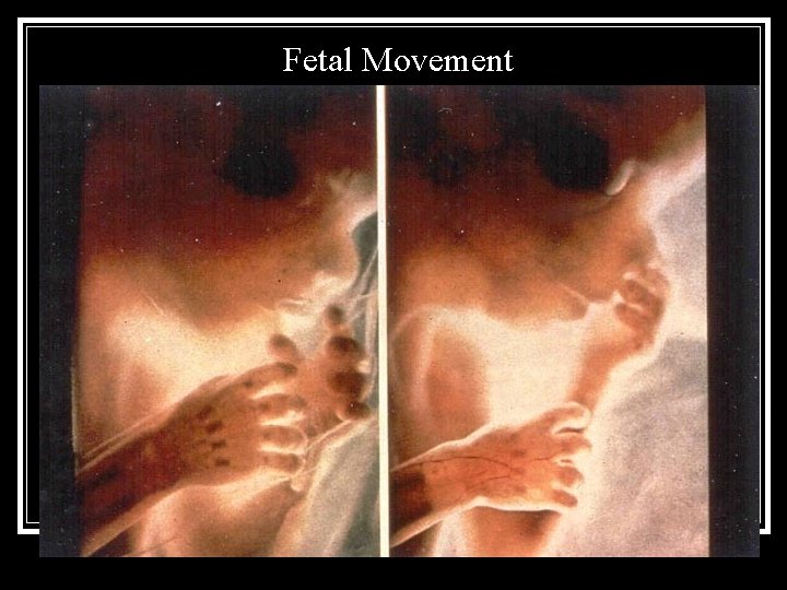 Fetal Movement 