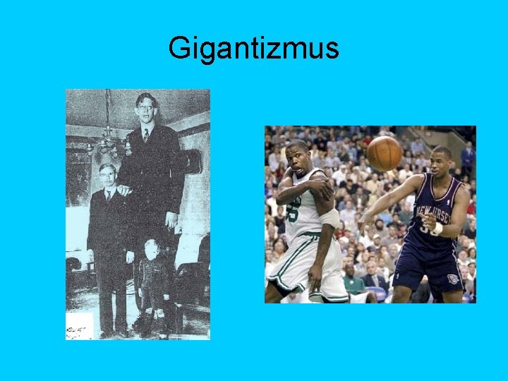 Gigantizmus 