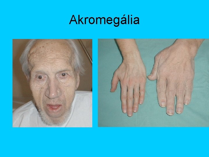 Akromegália 