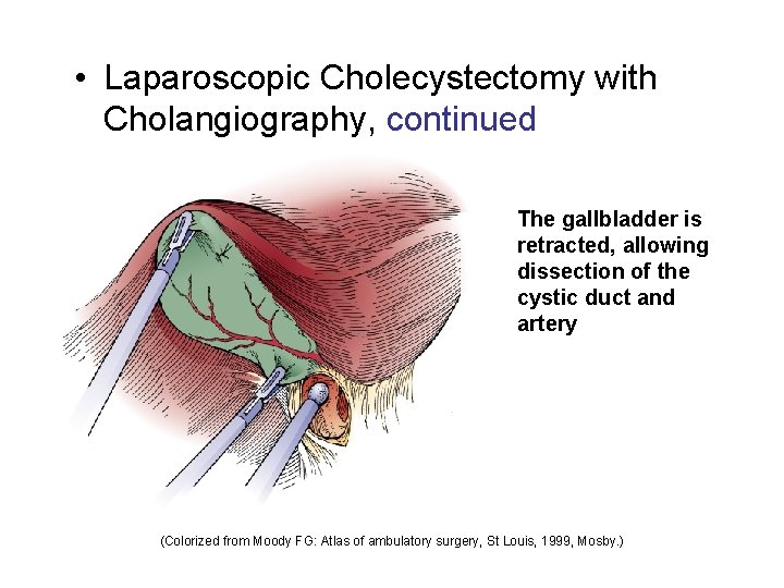  • Laparoscopic Cholecystectomy with Cholangiography, continued The gallbladder is retracted, allowing dissection of