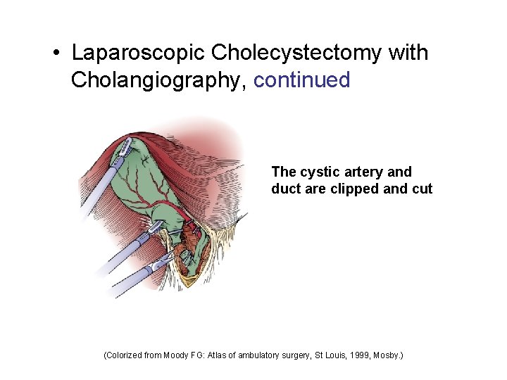  • Laparoscopic Cholecystectomy with Cholangiography, continued The cystic artery and duct are clipped