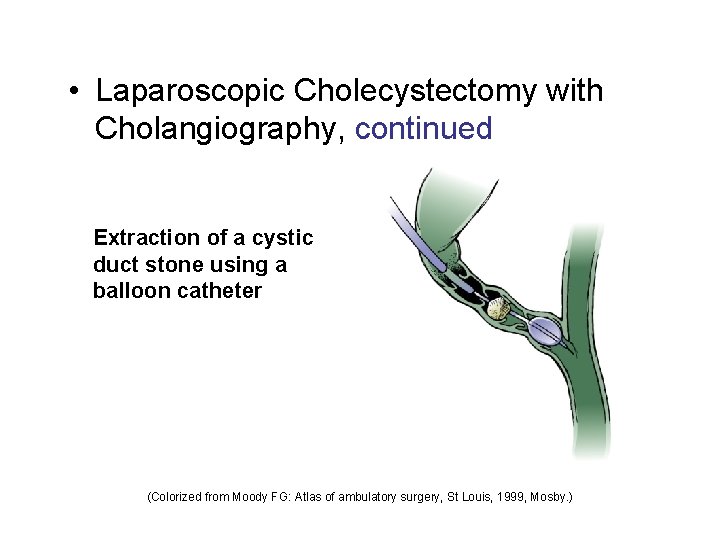  • Laparoscopic Cholecystectomy with Cholangiography, continued Extraction of a cystic duct stone using