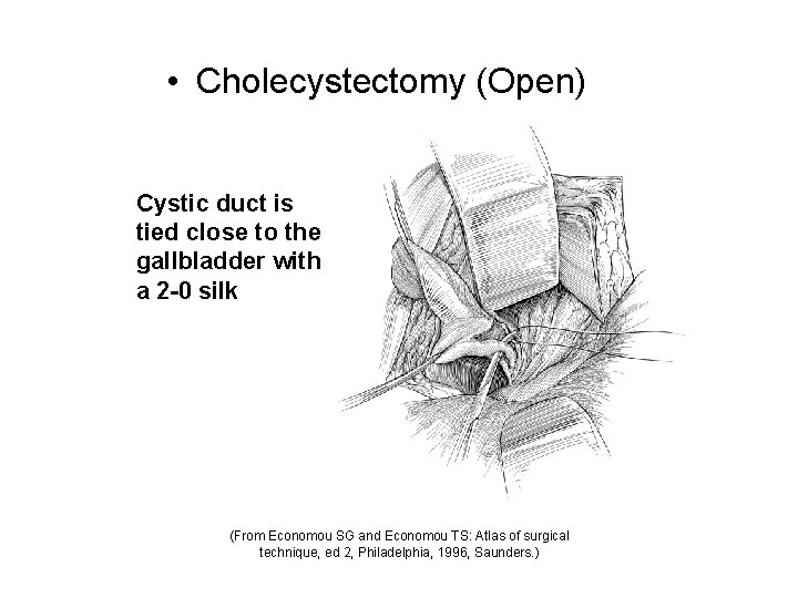  • Cholecystectomy (Open) Cystic duct is tied close to the gallbladder with a