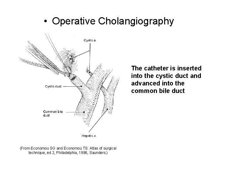  • Operative Cholangiography The catheter is inserted into the cystic duct and advanced