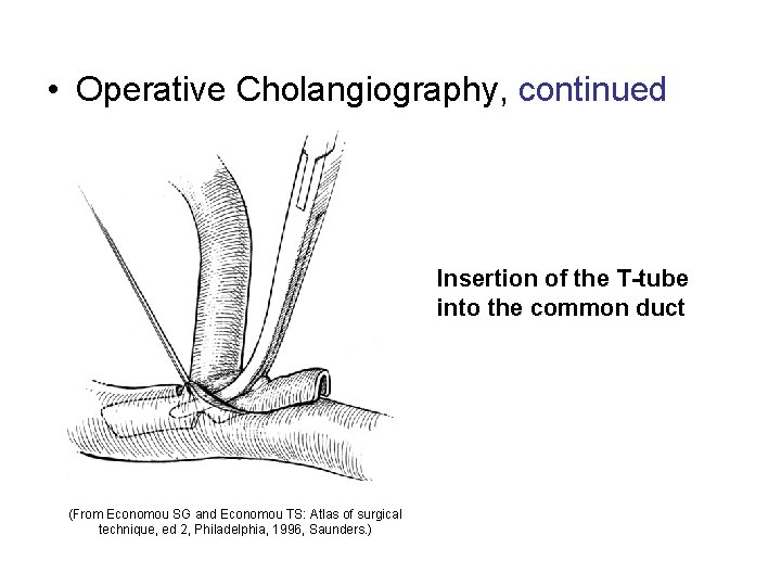  • Operative Cholangiography, continued Insertion of the T-tube into the common duct (From