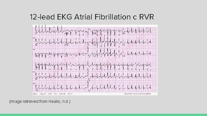 12 -lead EKG Atrial Fibrillation c RVR (Image retrieved from Healio, n. d. )