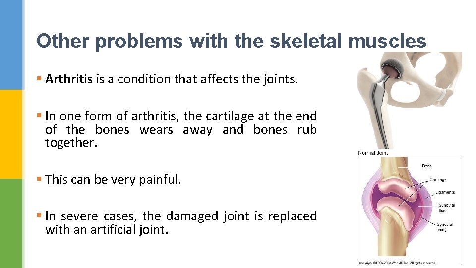 Other problems with the skeletal muscles § Arthritis is a condition that affects the