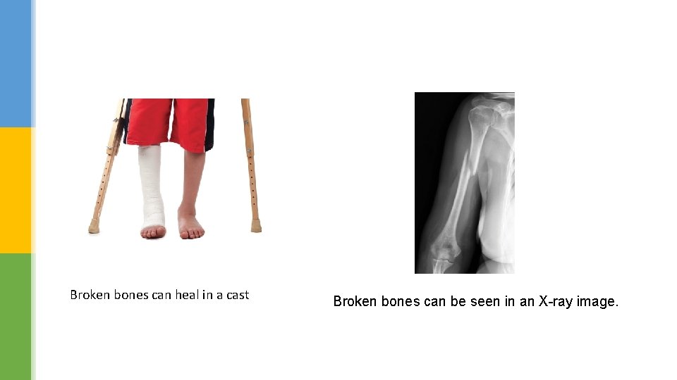 Broken bones can heal in a cast Broken bones can be seen in an