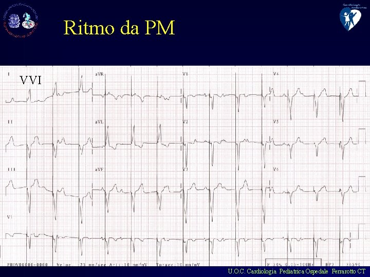 Ritmo da PM VVI U. O. C. Cardiologia Pediatrica Ospedale Ferrarotto CT 