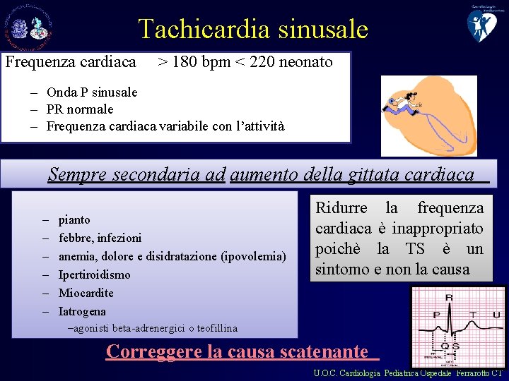 Tachicardia sinusale Frequenza cardiaca > 180 bpm < 220 neonato – Onda P sinusale