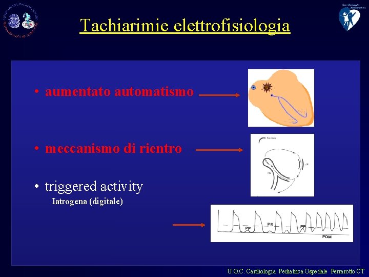 Tachiarimie elettrofisiologia • aumentato automatismo • meccanismo di rientro • triggered activity Iatrogena (digitale)