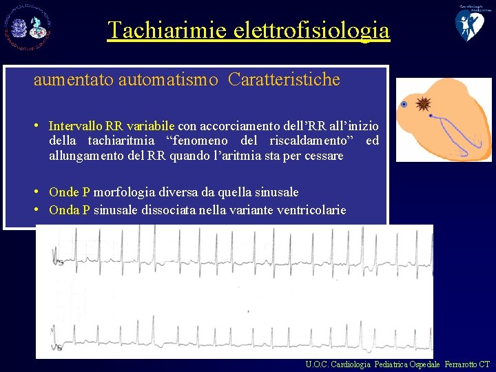 Tachiarimie elettrofisiologia aumentato automatismo Caratteristiche • Intervallo RR variabile con accorciamento dell’RR all’inizio della