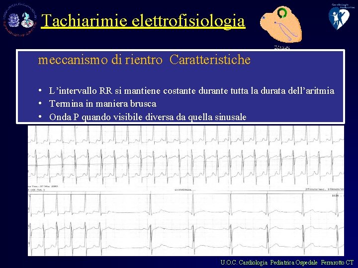 Tachiarimie elettrofisiologia meccanismo di rientro Caratteristiche • L’intervallo RR si mantiene costante durante tutta