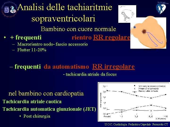 Analisi delle tachiaritmie sopraventricolari Bambino con cuore normale • + frequenti rientro RR regolare