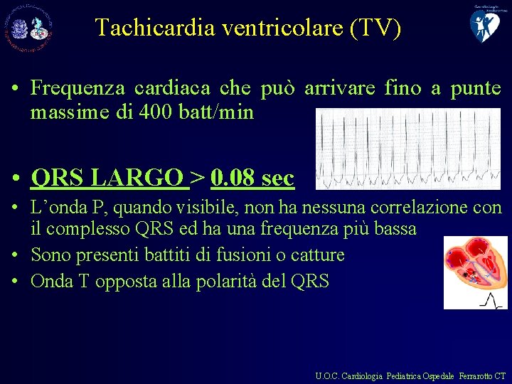 Tachicardia ventricolare (TV) • Frequenza cardiaca che può arrivare fino a punte massime di