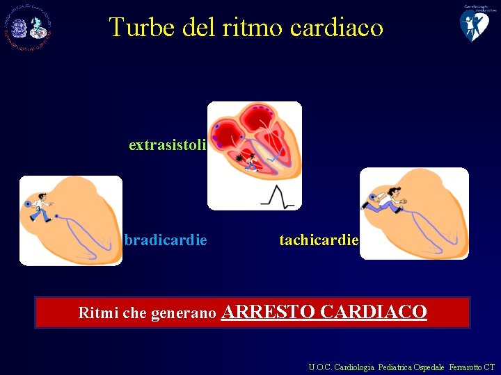 Turbe del ritmo cardiaco extrasistoli bradicardie tachicardie Ritmi che generano ARRESTO CARDIACO U. O.