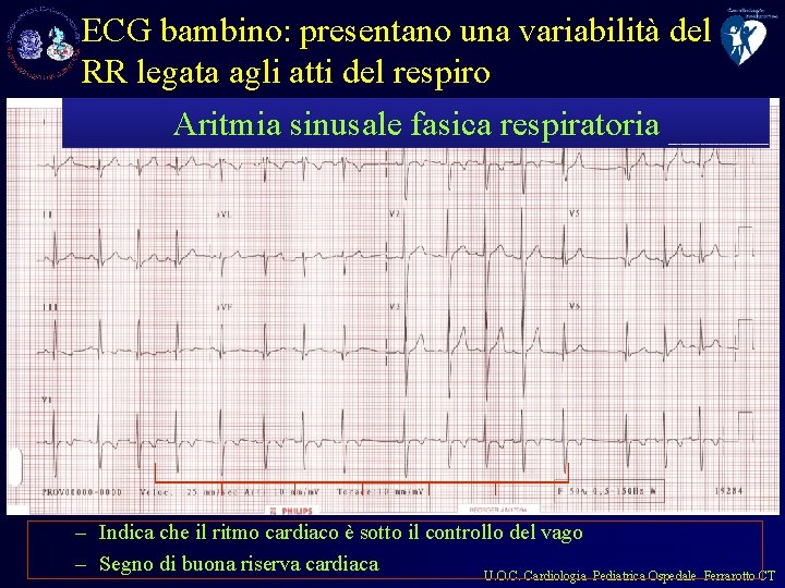 ECG bambino: presentano una variabilità del RR legata agli atti del respiro Aritmia sinusale