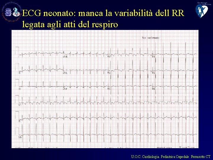 ECG neonato: manca la variabilità dell RR legata agli atti del respiro U. O.