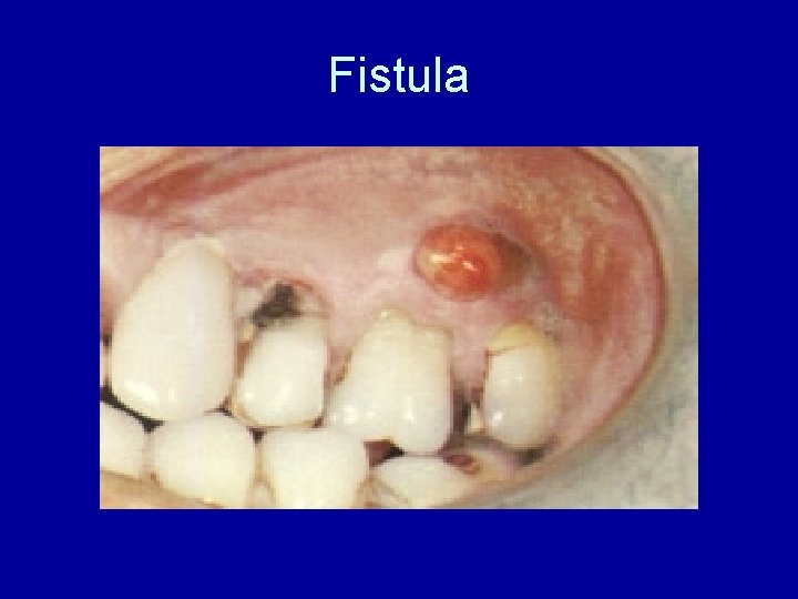 Fistula 