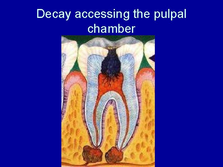 Decay accessing the pulpal chamber 
